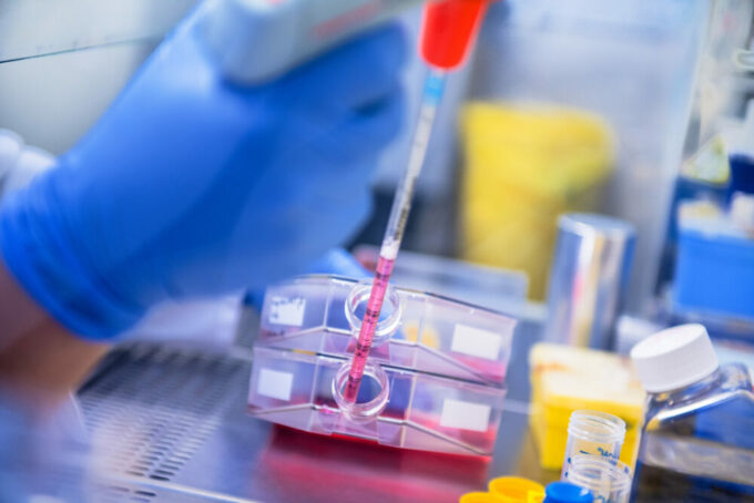 Blasenkrebs: Wann ist eine Chemotherapie sinnvoll?